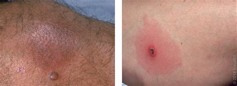 Spider Bite Bump