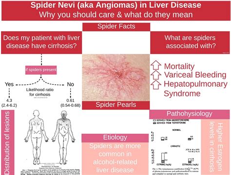 Spider Naevi In Cirrhosis
