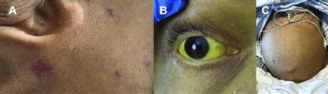 Spider Nevi In Cirrhosis