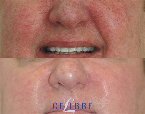 Spider Veins On Cheeks