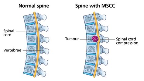 Spinal Cord Neoplasm Symptoms