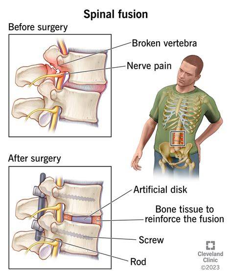 Spinal Fusion Recovery