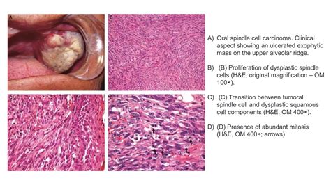 Spindle Cell Carcinoma