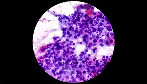 Spindle Cell Tumor