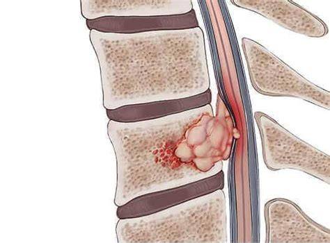 Spine Cancer Symptoms