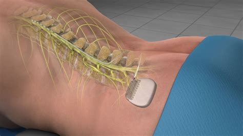 Spine Stimulator Implant