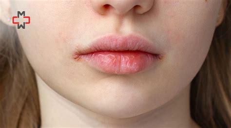 Split Lip Corner