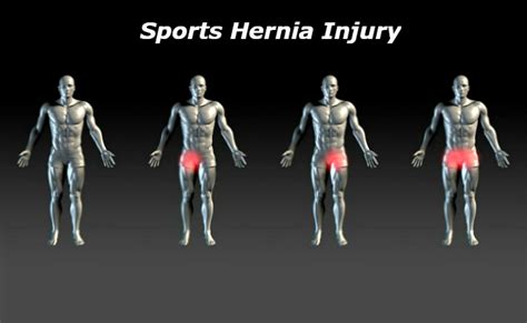Sports Hernia Symptoms