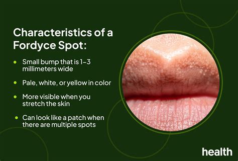 Spots On Lips Fordyce