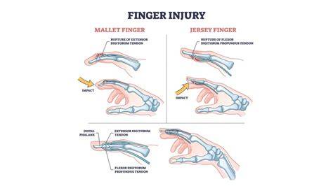 Sprain Or Break Finger