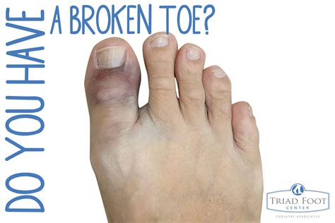 Sprained Big Toe