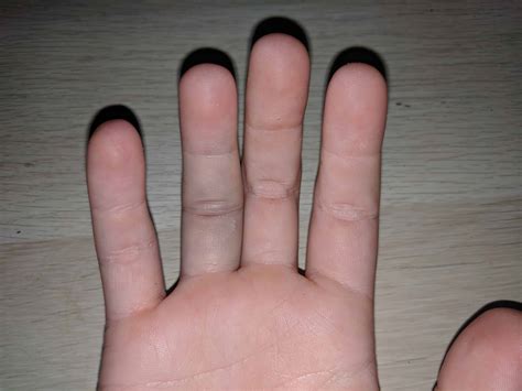 Sprained Finger Symptoms