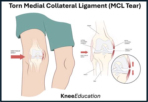 Sprained Mcl Ligament