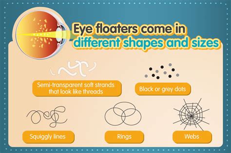 Squiggly Lines In Eyesight
