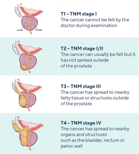Stage 2 Prostate Cancer