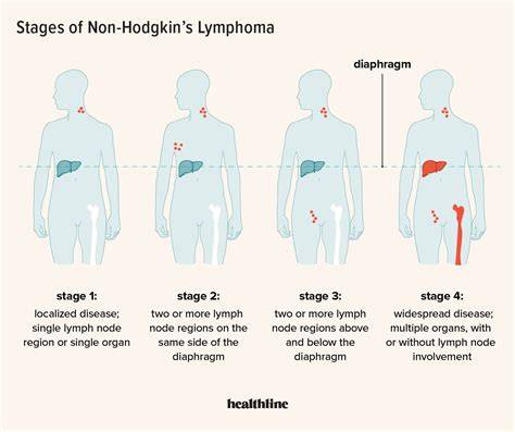 Stage 3 Lymphoma