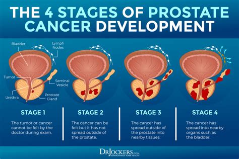 Stage 3 Prostate Cancer