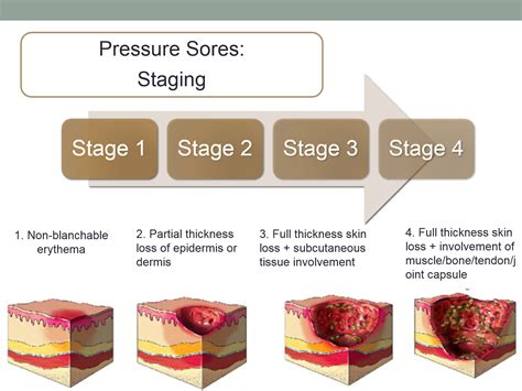 Stage 3 Wound