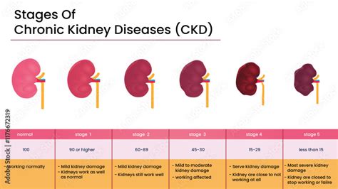 Stage 4 Chronic Kidney Disease