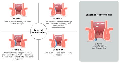 Stage 4 Hemorrhoids