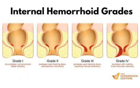 Stage Four Hemorrhoid