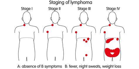 Stage Iii Lymphoma Cancer