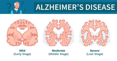 Stages Of Alzheimer's