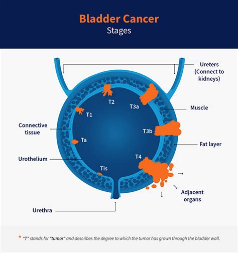 Stages Of Bladder Cancer