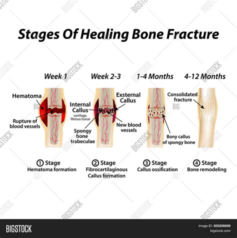 Stages Of Bone Healing