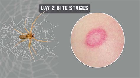 Stages Of Brown Recluse Bite