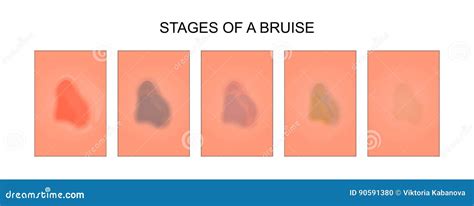 Stages Of Bruising