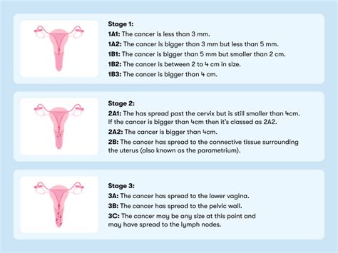 Stages Of Cervical Cancer