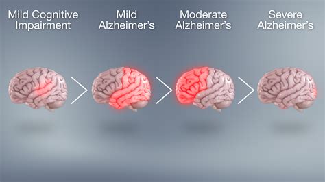 Stages Of Early Onset Alzheimer's