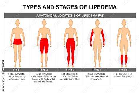 Stages Of Lipedema