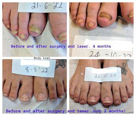 Stages Of Nail Growing Back