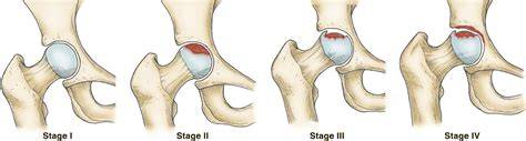 Stages Of Osteoarthritis Of The Hip