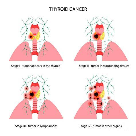 Stages Of Thyroid Cancer