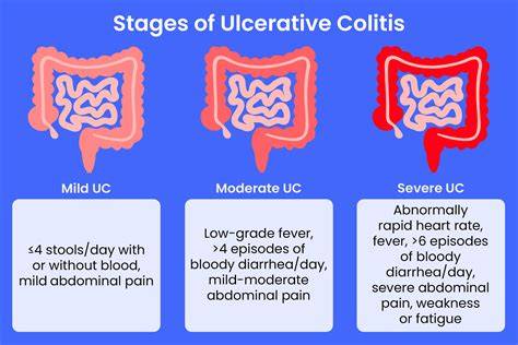 Stages Of Ulcerative Colitis