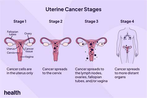 Stages Of Uterine Cancer Chart
