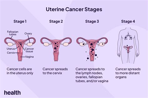 Stages Of Uterine Cancer