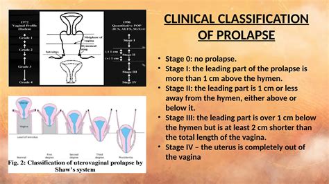 Stages Of Vaginal Prolapse