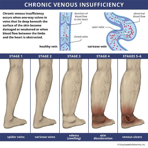 Stages Of Venous Insufficiency