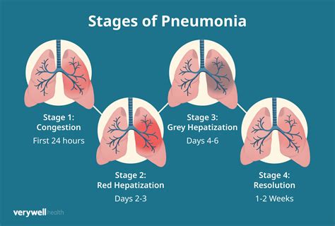 Stages Of Walking Pneumonia