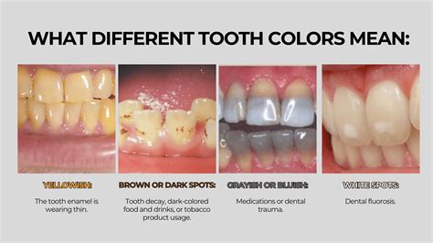 Stages Of Yellow Teeth