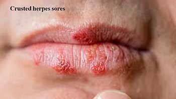 Std From Kissing