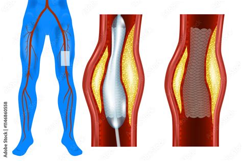 Stent In Leg