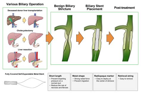 Stent In Liver Duct
