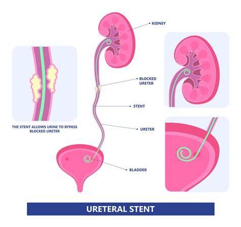 Stent In Ureter