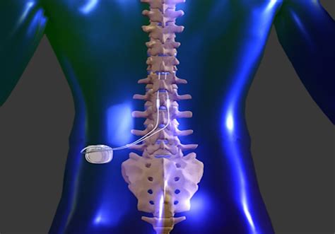 Stimulator For Back Pain