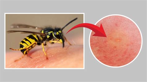 Sting Of A Wasp